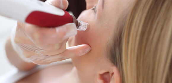 Mesotherapy microneedle, the woman at the beautician