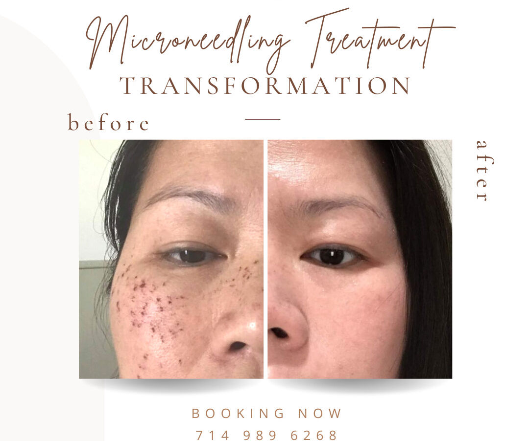 Why BB Glow/ Microneeddling becomes one of the best choice to improve your skin? 1