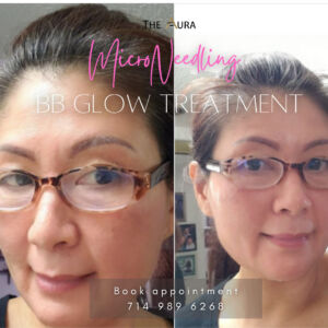 BB Glow Microneedling Online Learning with Aura Beauty Academy 1
