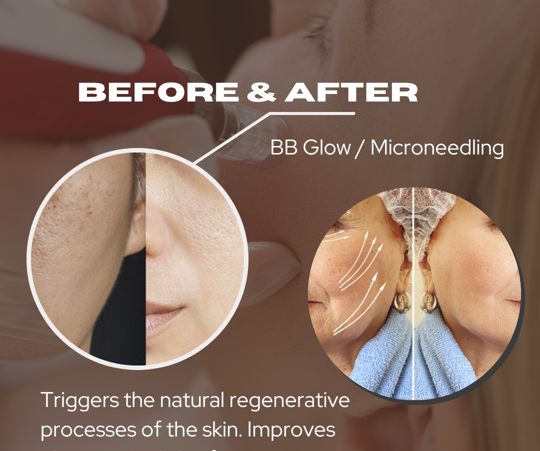 Discover natural beauty with BB Glow and Micro-needling with Aura Beauty in Orange County