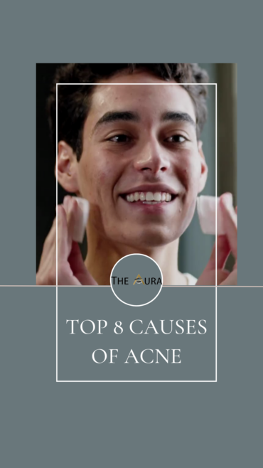 Top 8 causes of acne