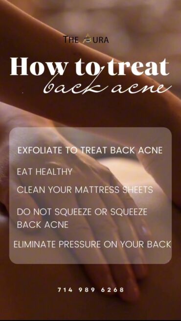☘How to treat back acne at home for both men and women☘