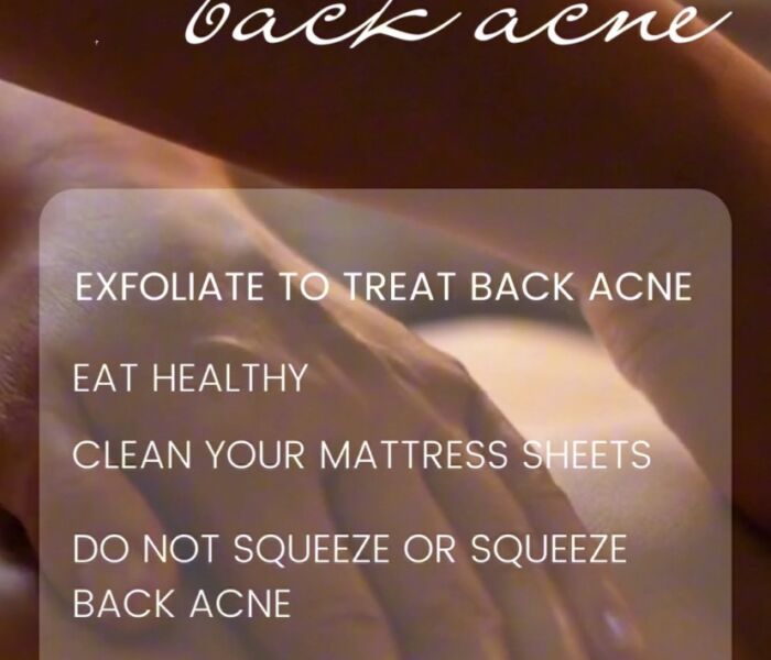 ☘How to treat back acne at home for both men and women☘